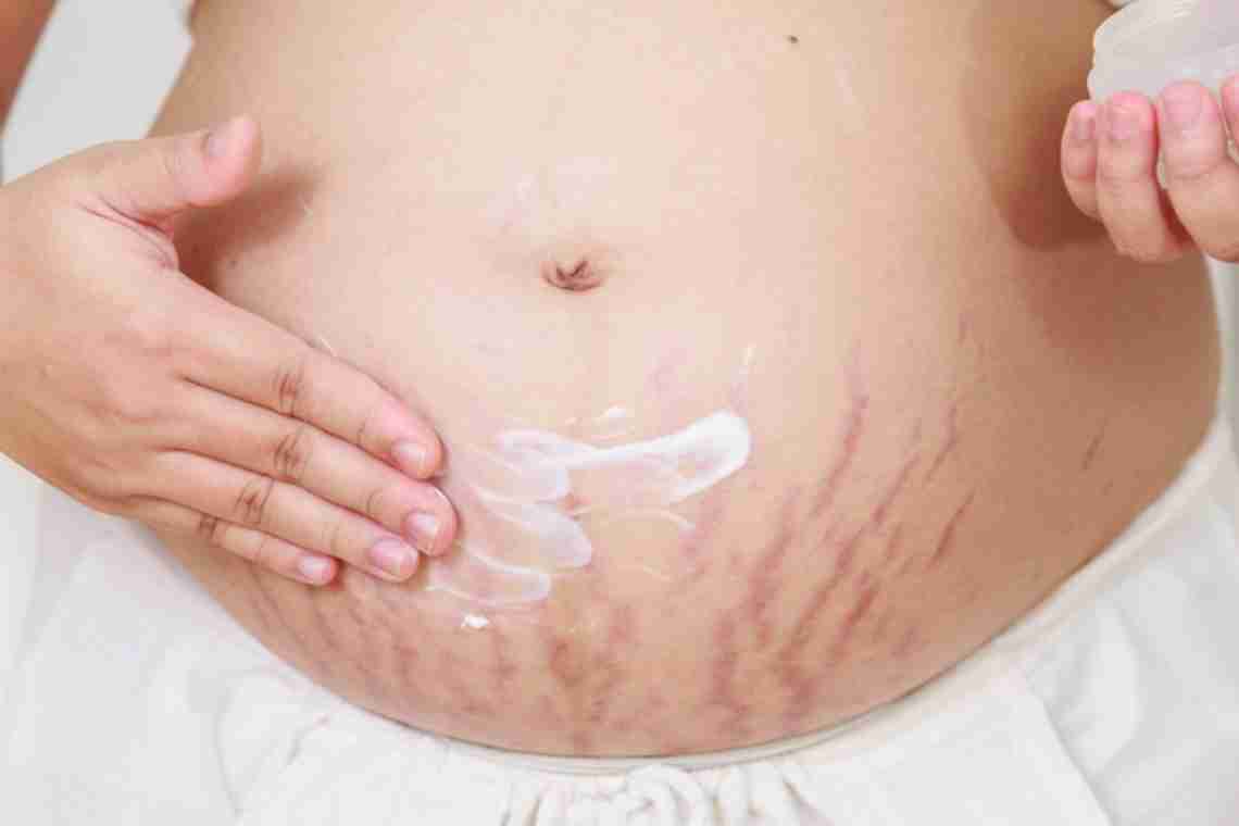 Розтяжки при вагітності: що робити, як уникнути?