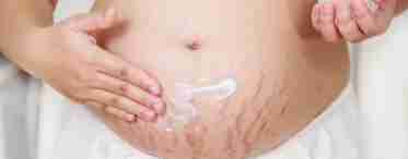 Розтяжки при вагітності: що робити, як уникнути?