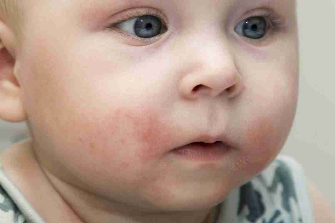 Алергія на гречку біля грудничка: перші ознаки і способи лікування