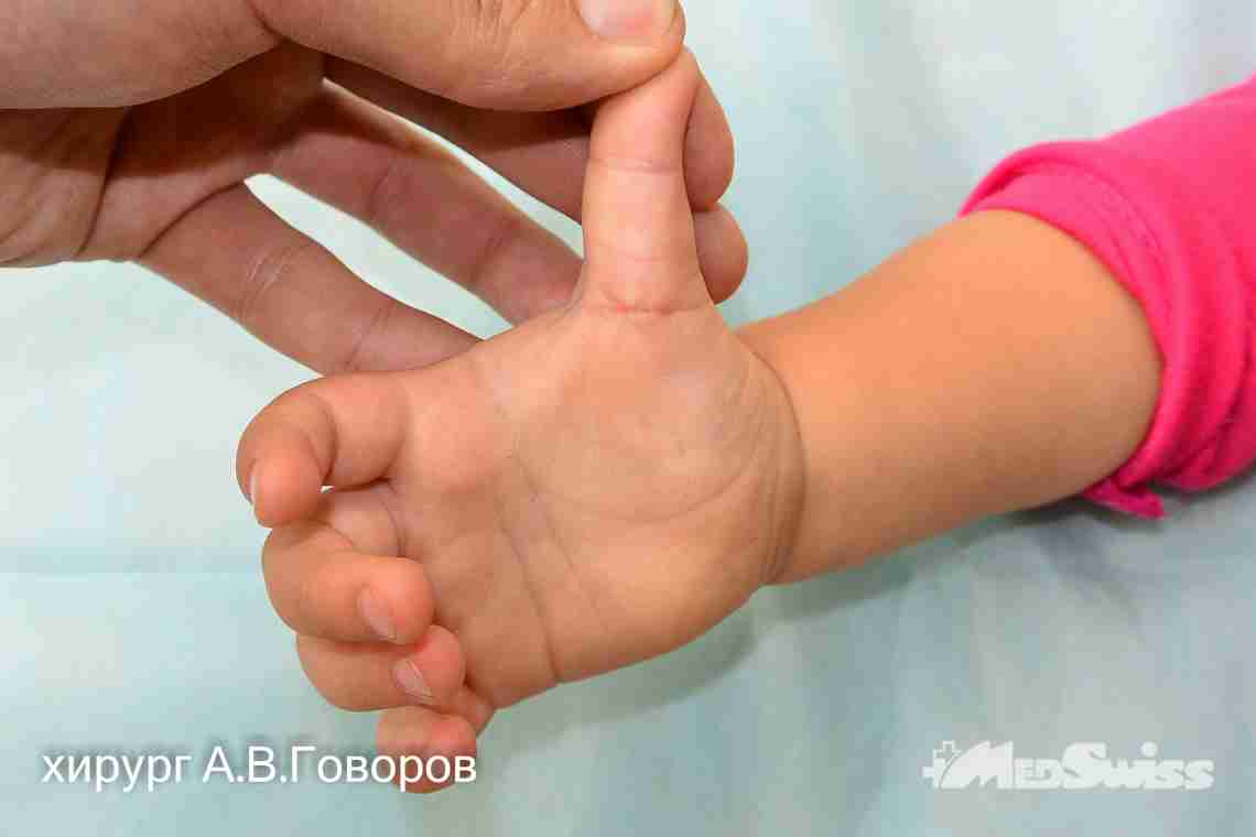 Облізла шкірка на пальчиках немовляти - 10 поширених причин патології