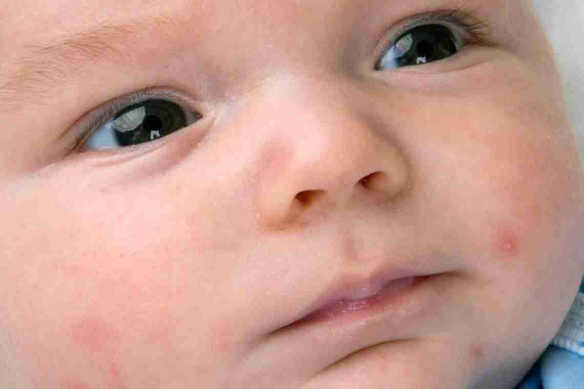 Прищі у новонароджених: види, причини появи, лікування