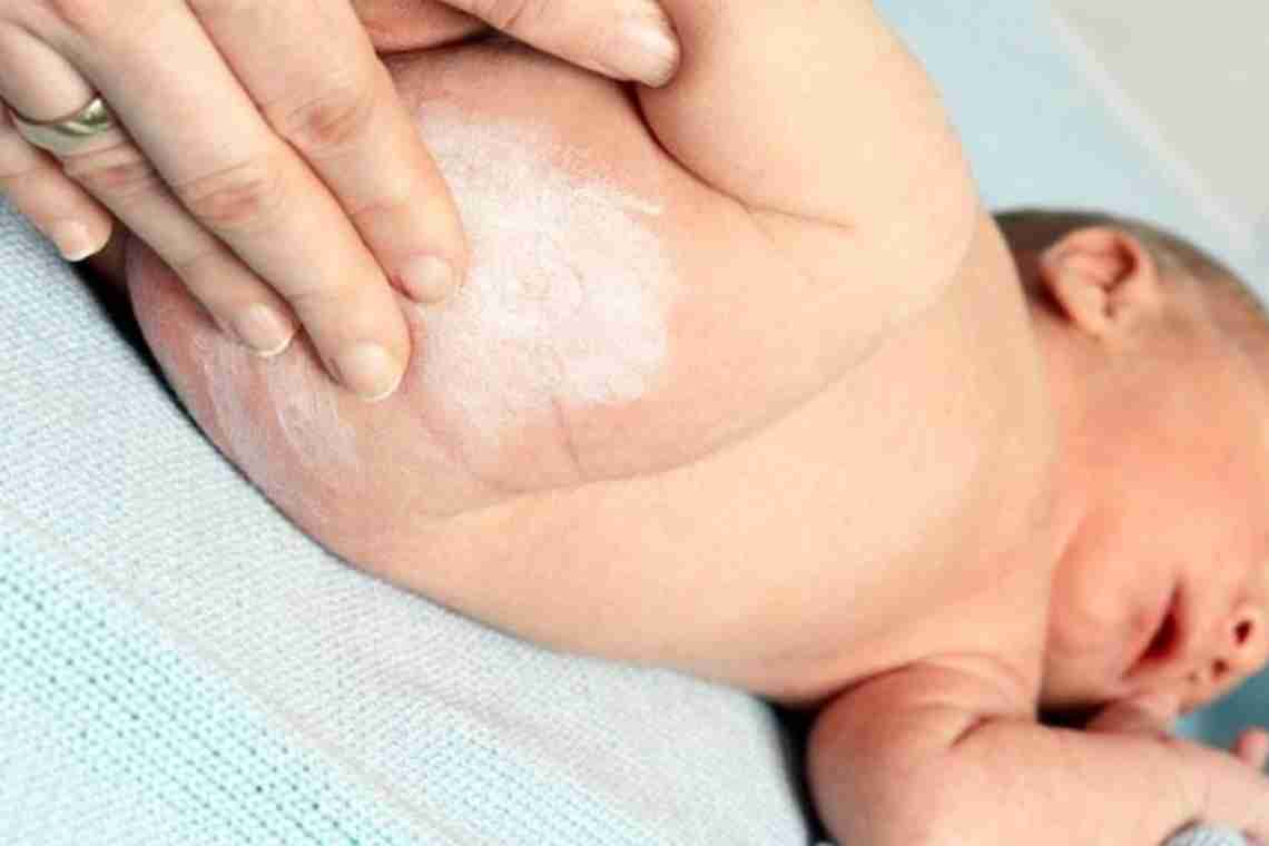 Причини та лікування мармурової шкіри біля грудничка