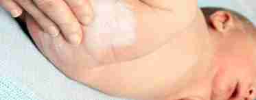 Причини та лікування мармурової шкіри біля грудничка