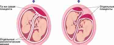 Багатоплідна вагітність: монохоріальна і дихоріальна двійня