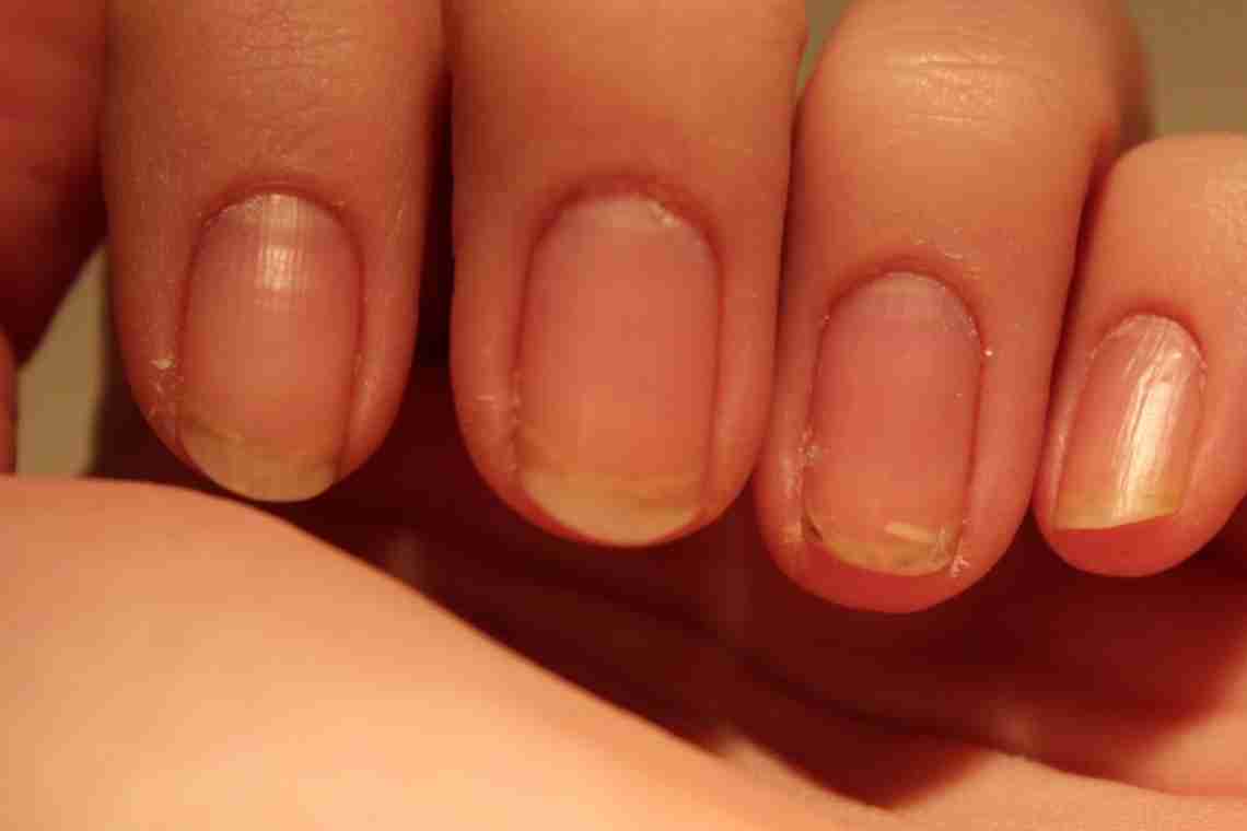 Синіють нігті на руках: причини та лікування