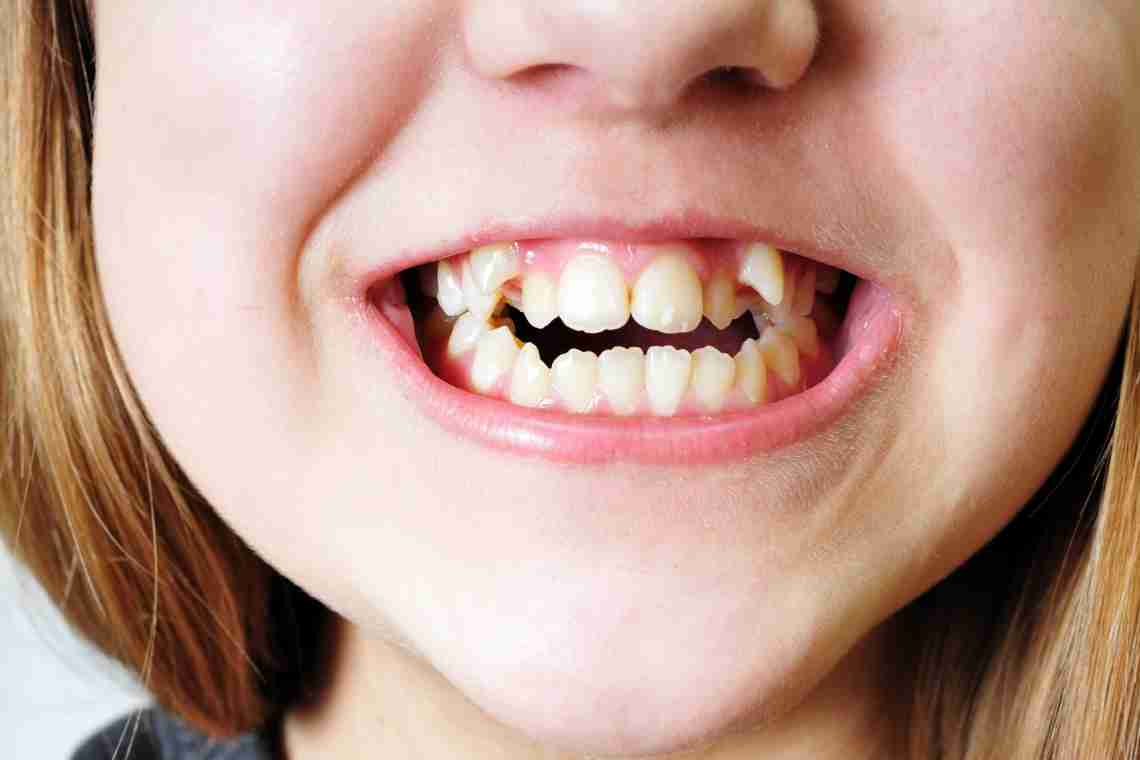 Очні зуби: чому з ними виникають проблеми і як їх уникнути?