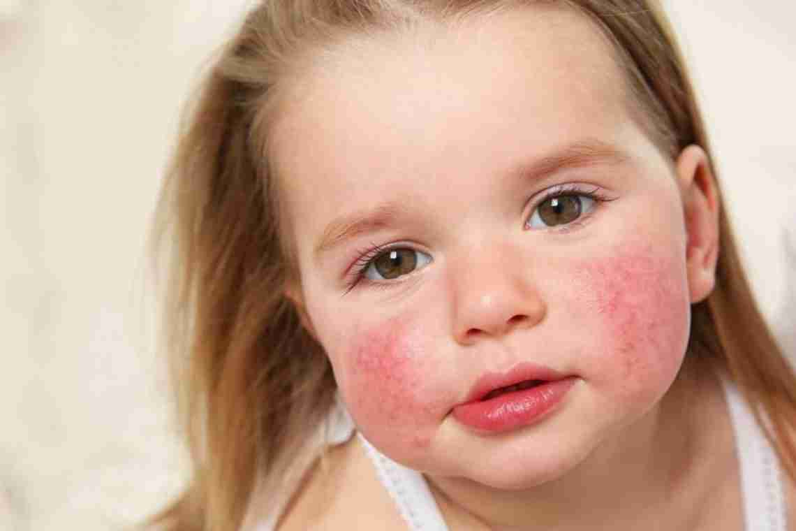 Чим небезпечна алергія на сонці?