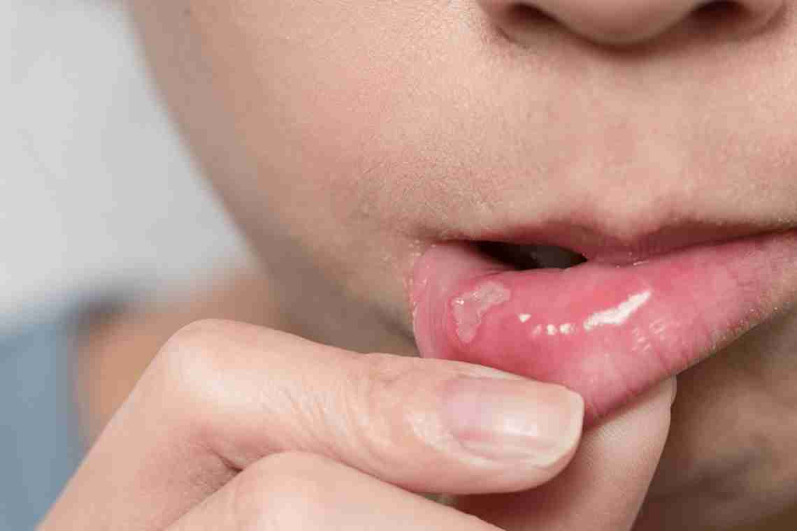 Як можна вилікувати ранки в роті?