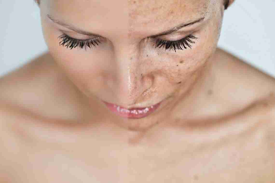Як використовувати ефірну олію від пігментних плям на обличчі?
