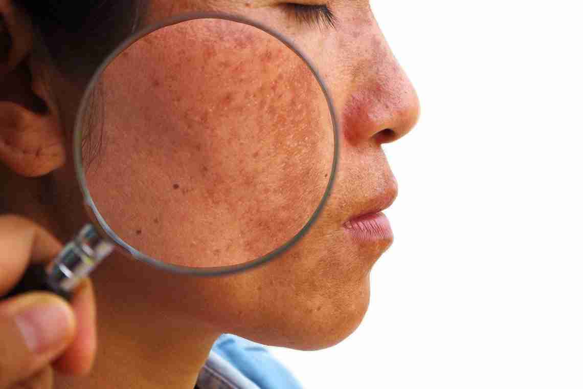 Пігментні плями після пологів на обличчі і тілі: причини появи, способи усунення, профілактика