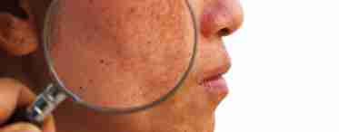 Пігментні плями після пологів на обличчі і тілі: причини появи, способи усунення, профілактика