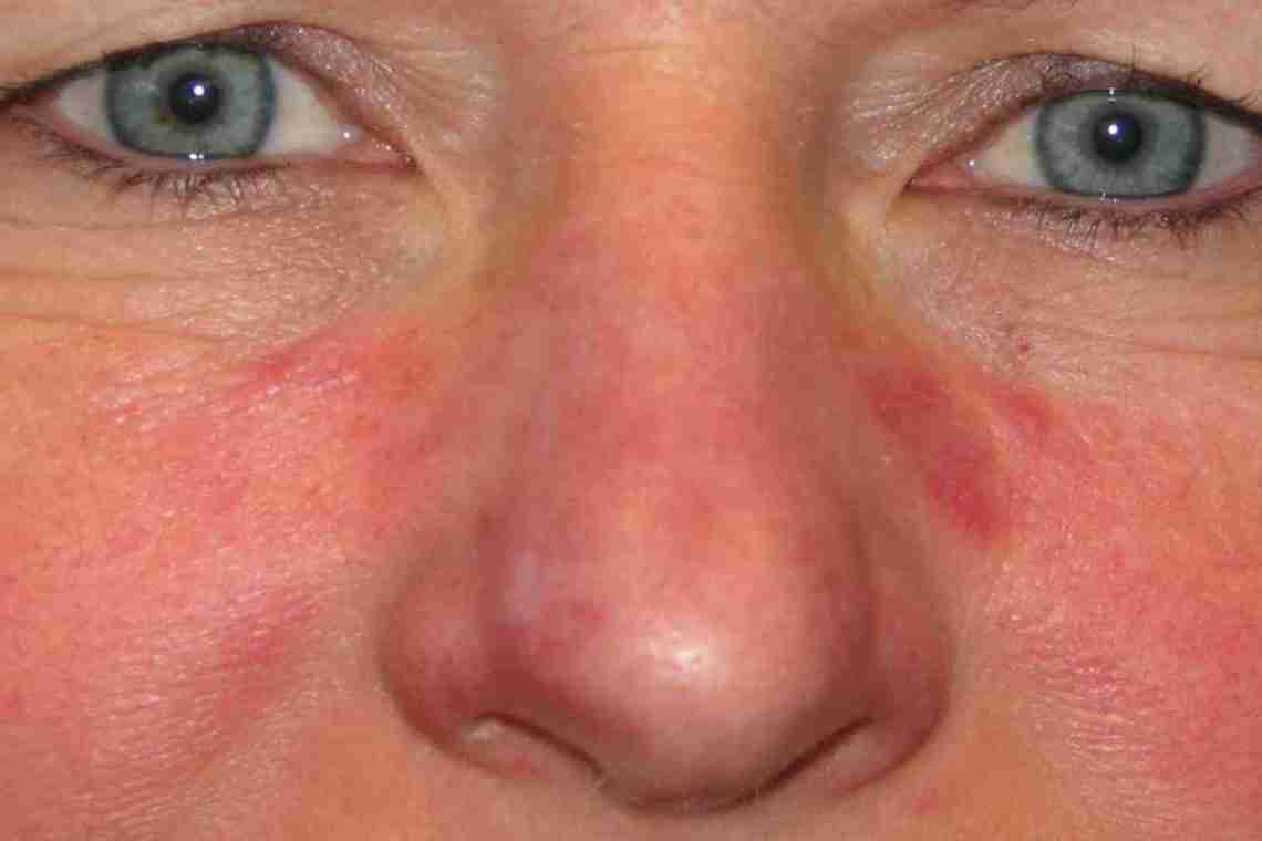 Почервоніння і лушпіння шкіри на обличчі: причини та лікування
