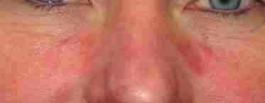 Почервоніння і лушпіння шкіри на обличчі: причини та лікування
