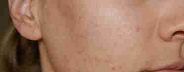 Проблемна шкіра обличчя: домашнє лікування прищів і вугрів