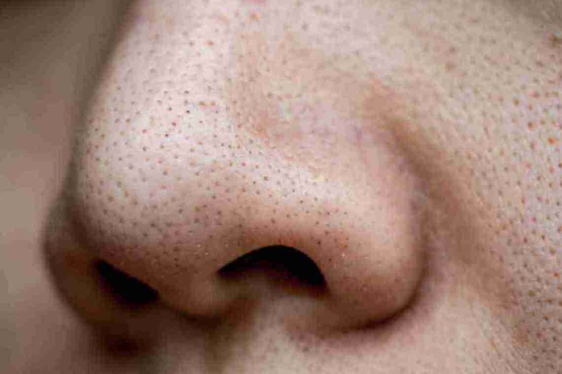 Приховища на носі та переносиці: види, причини, лікування вугрів