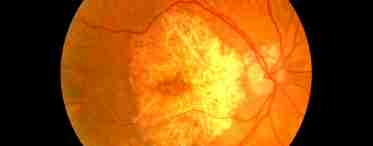 Фіброз сітківки ока - мембрана, яка затуманює погляд
