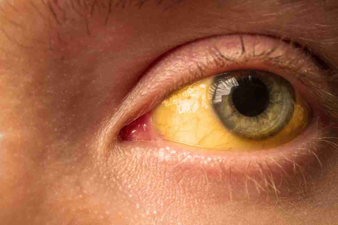 Чому червоніють білки очей і що з цим робити?