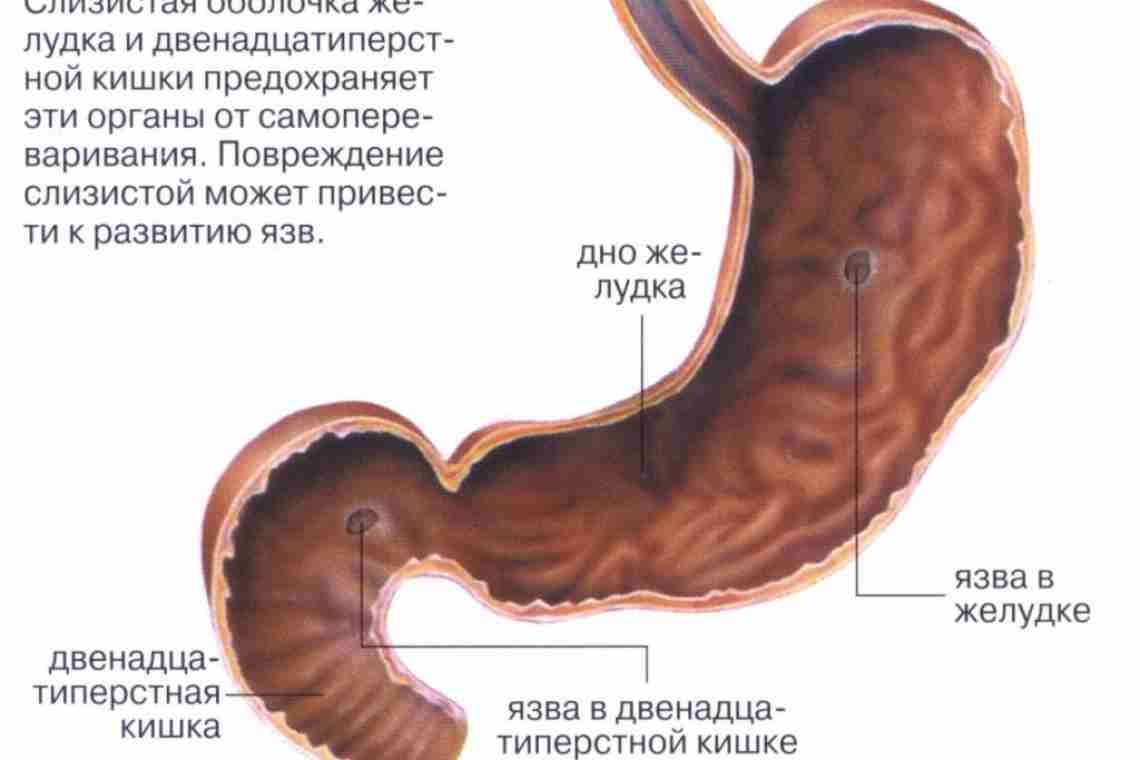 Дієта і меню при ерозії слизової шлунка і дванадцятипалої кишки