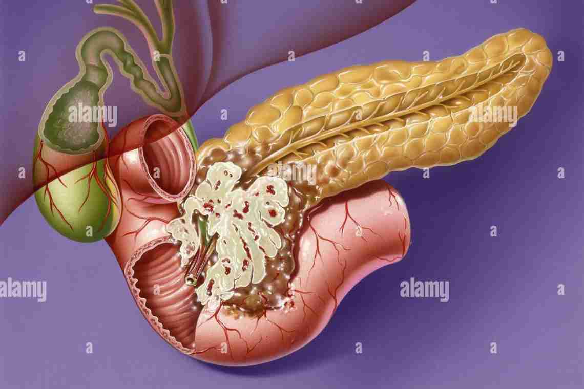 Як відновити підшлункову залозу після панкреатиту в домашніх умовах?