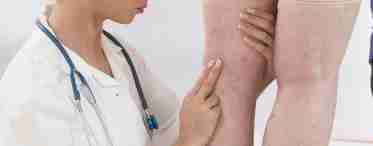 Лімфостаз руки після видалення молочної залози: симптоми і лікування