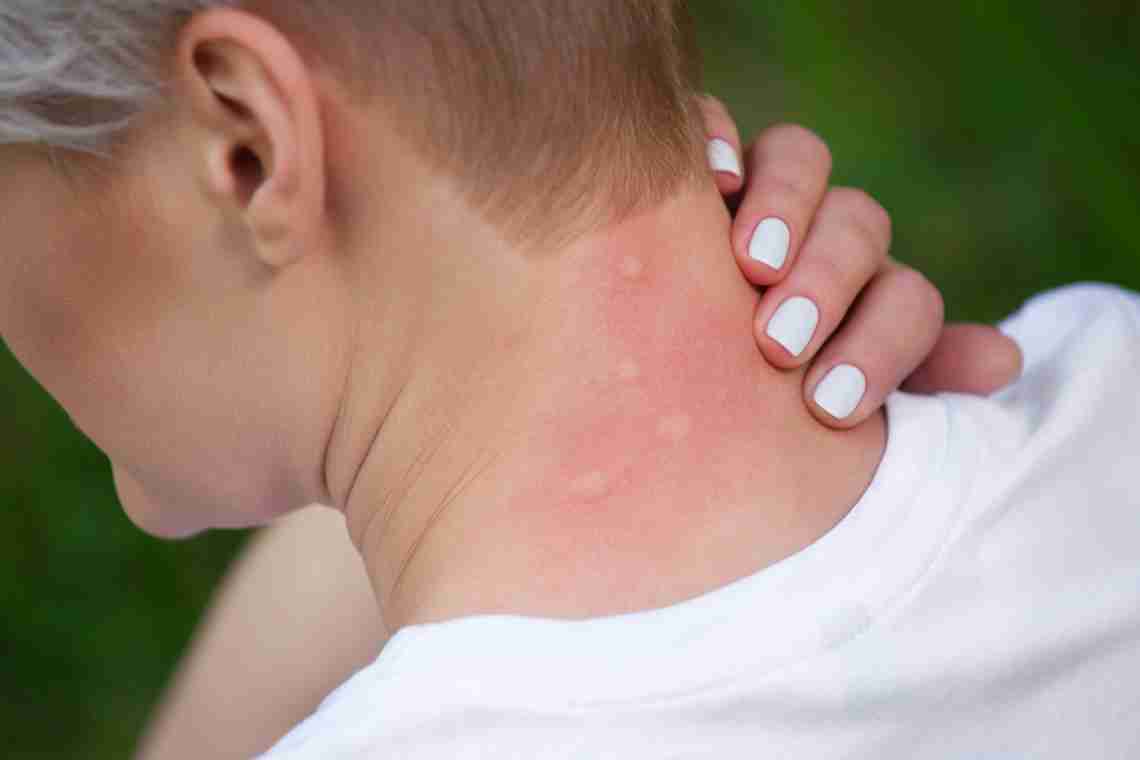 Алергія на ногах: що робити при появі у дітей і дорослих?
