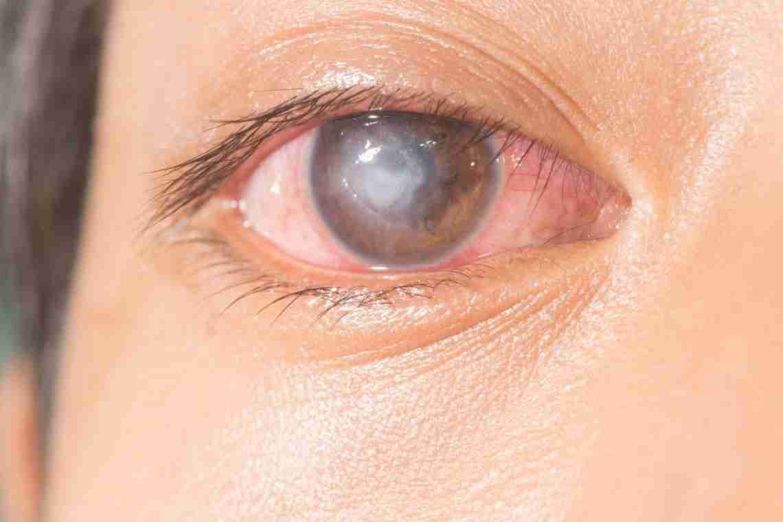Набряк рогівки ока: методи лікування