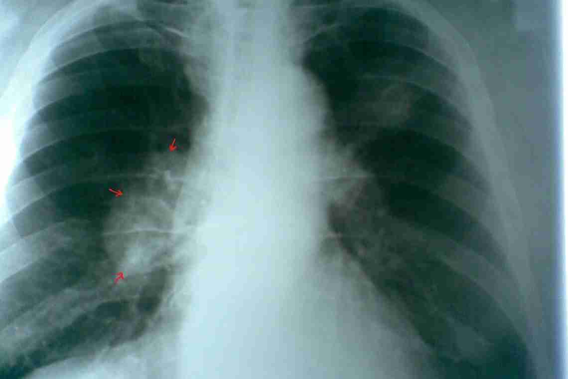 Як виявити саркоїдоз легенів?