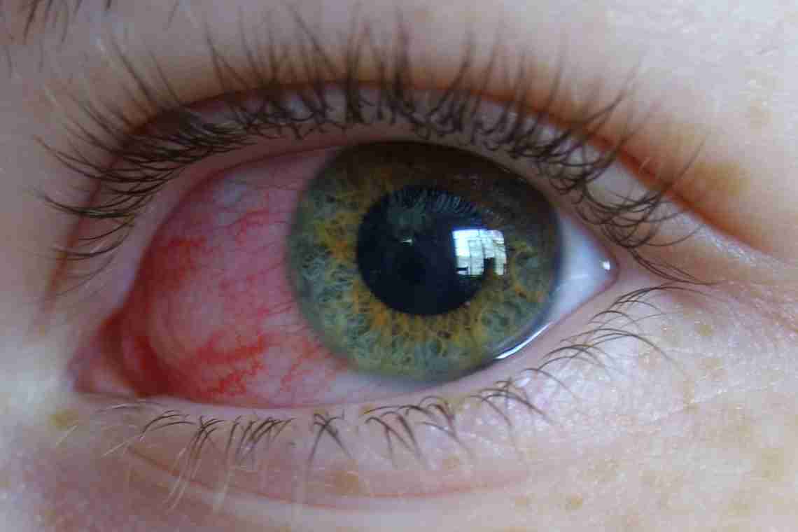 Сльозливість очей - норма чи патологія?