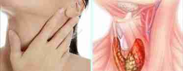 Причини, симптоми, види та лікування вузлів на щитовидку