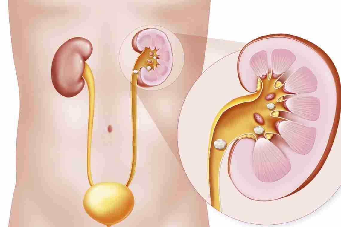 Кальцинати в нирках: причини, симптоми, лікування