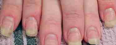 Грибок на руках у дитини: лікування нігтів у дітей