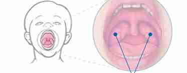Білі точки в горлі: чому з'являються і як їх усунути