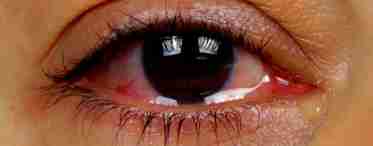 Чому око почервонів і сльозиться? Найкращі рецепти для зняття симптомів недуги
