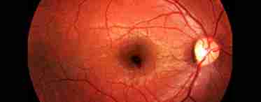 Симптоми та лікування хвороб сітківки ока