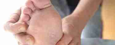Міжпальцевий грибок на ногах: лікування та виявлення патології