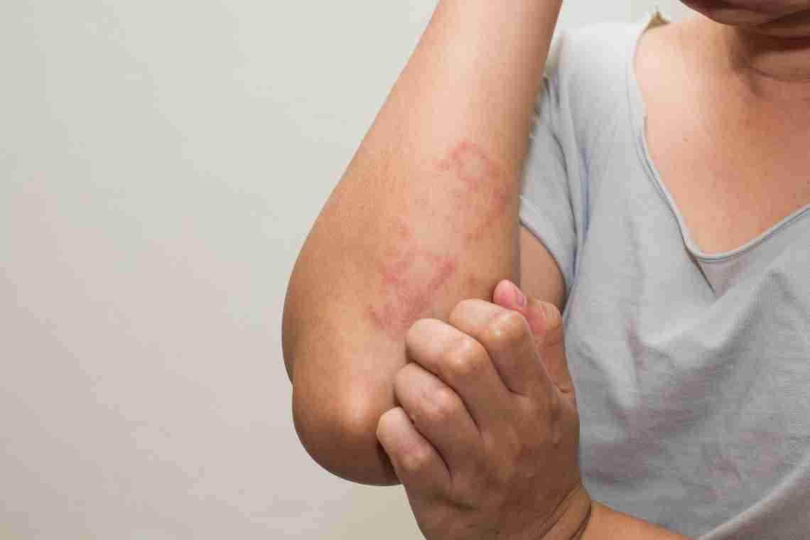 Чим лікувати алергічні висипання на шкірі?