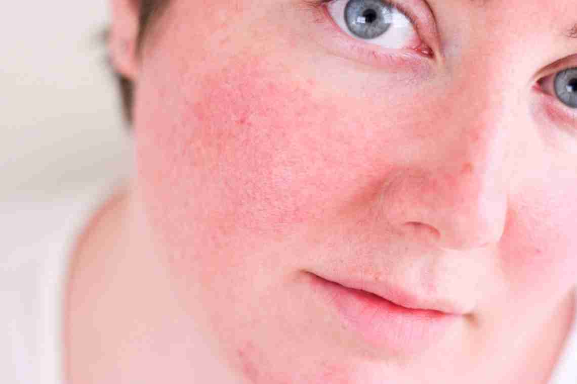 Алергічні висипання на обличчі: причини виникнення та методи лікування