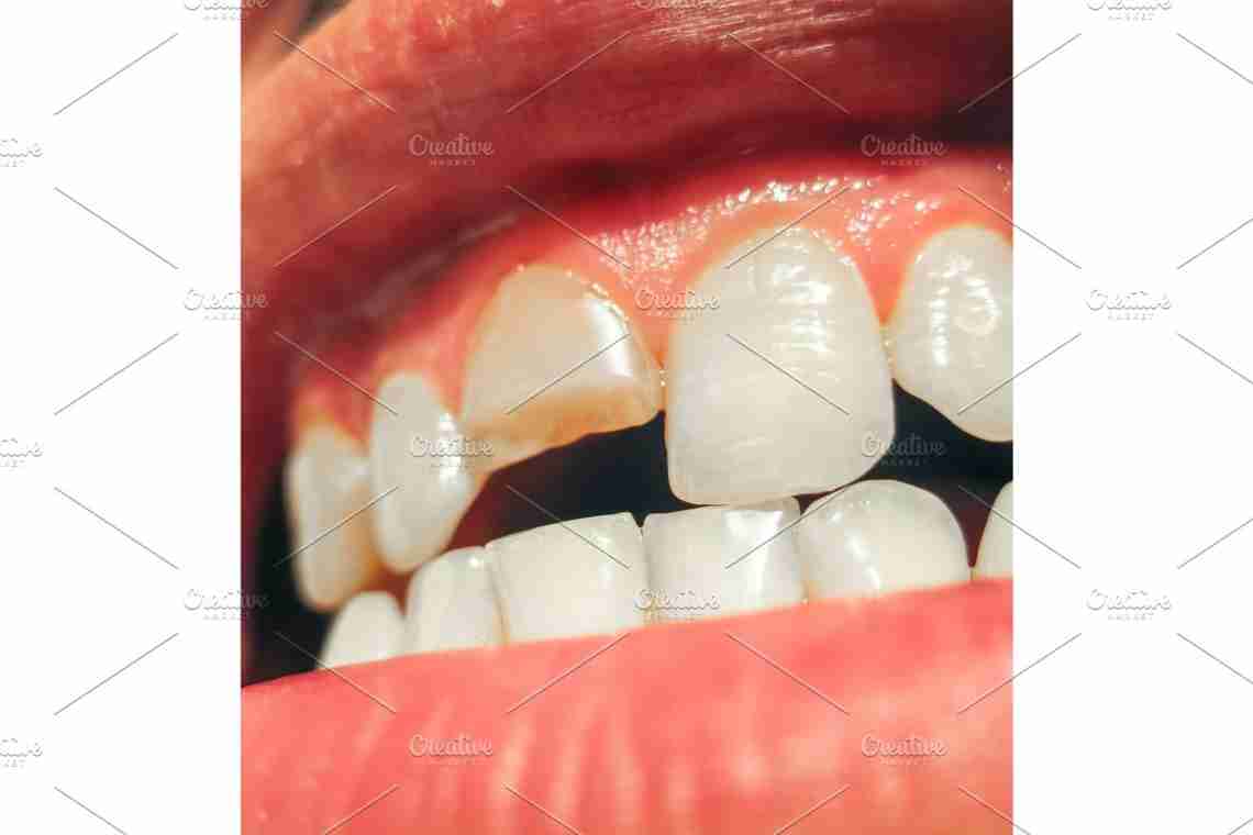 Поради, що потрібно робити, якщо відколовся шматочок зуба