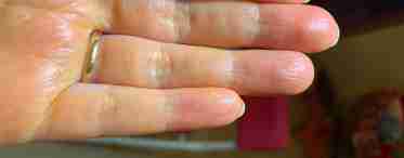 Шишки на фалангах пальців рук - незначний дефект або тривожний сигнал?