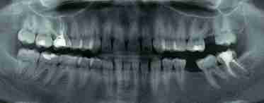 Кіста на корені зуба: позбуваємося болю