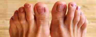 Зрослися пальці на ногах: що це означає і які причини виникнення синдактилії