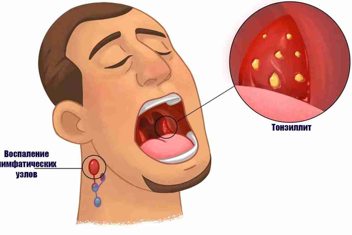 Болить горло, пухла десна: симптоми, діагностика та лікування ангіни