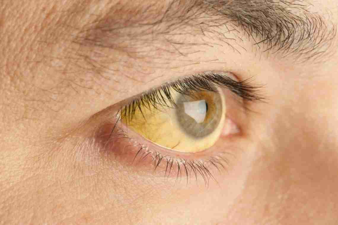 Жовті білки очей - це погано?