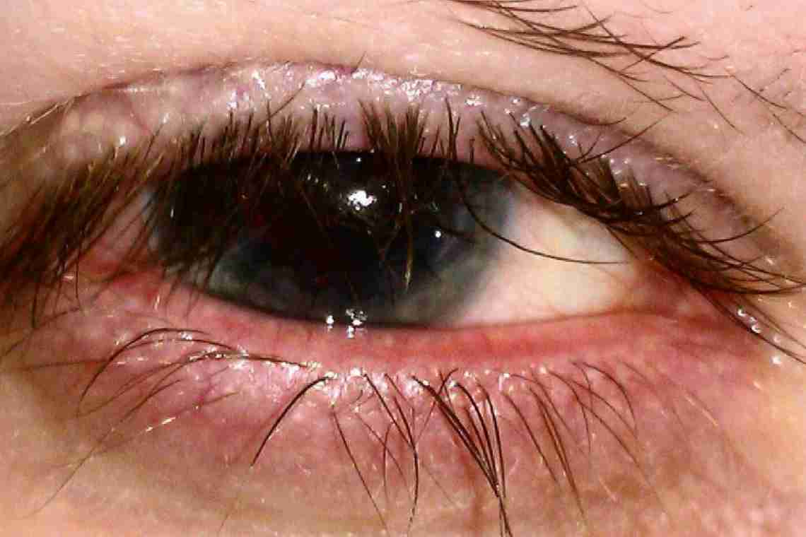 Блефарит - запалення століття ока