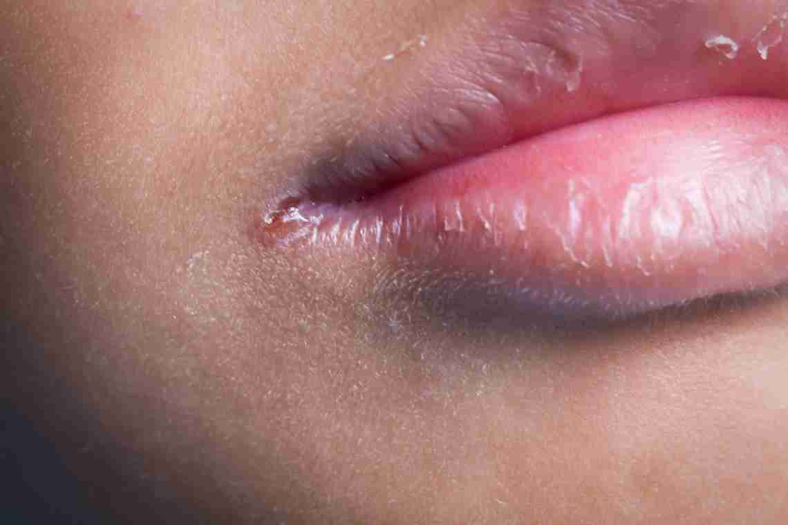 Волдир на губі у дитини - можливі причини та їх лікування
