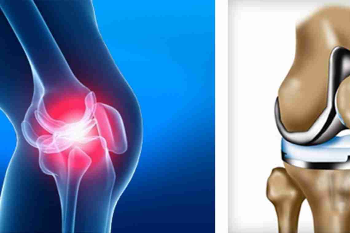 Шишка на коліні: що це може бути і як повернути здоров'я колінному суглобу?