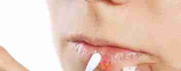 Чи можна герпес мазати йодом: як правильно лікувати застуду на губах