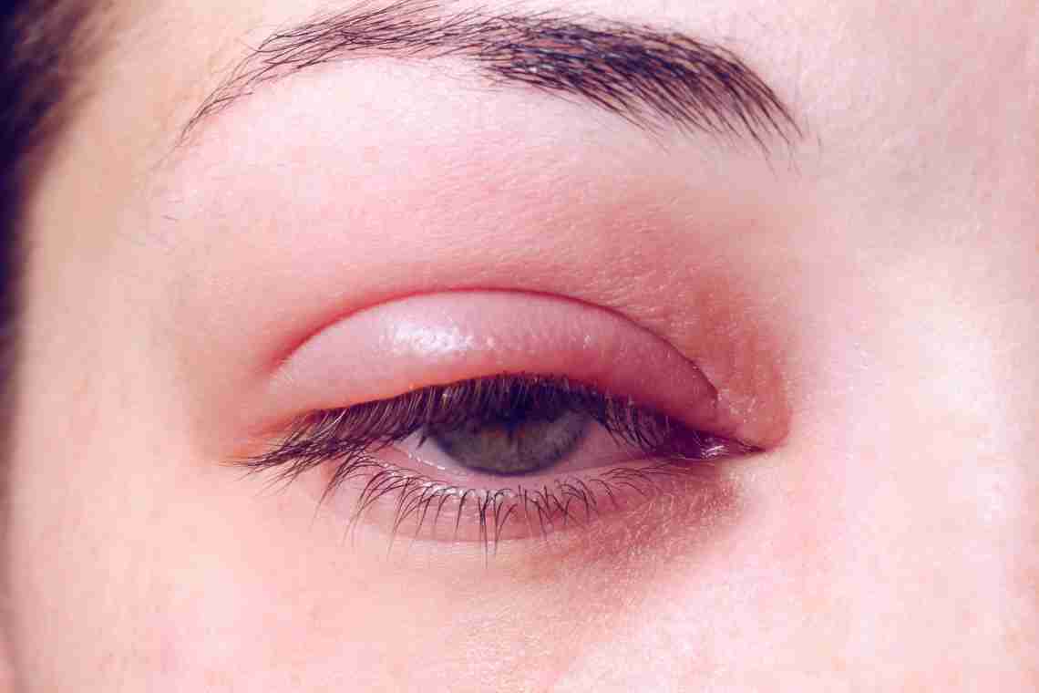 Герпес очі (офтальмогерпес)