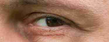 Чешуться повіки очей: опис причин хвороб та їх лікування
