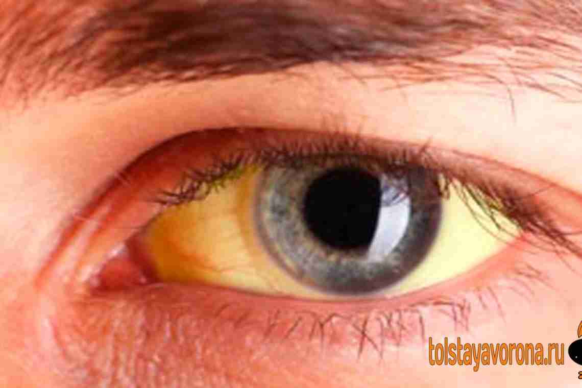 Що робити, якщо білки очей мають жовте забарвлення?
